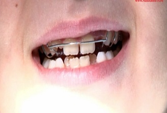 Specialist: Consultul pentru identificarea necesitatii aparatului dentar la copil ar trebui facut in jurul varstei de 5 ani