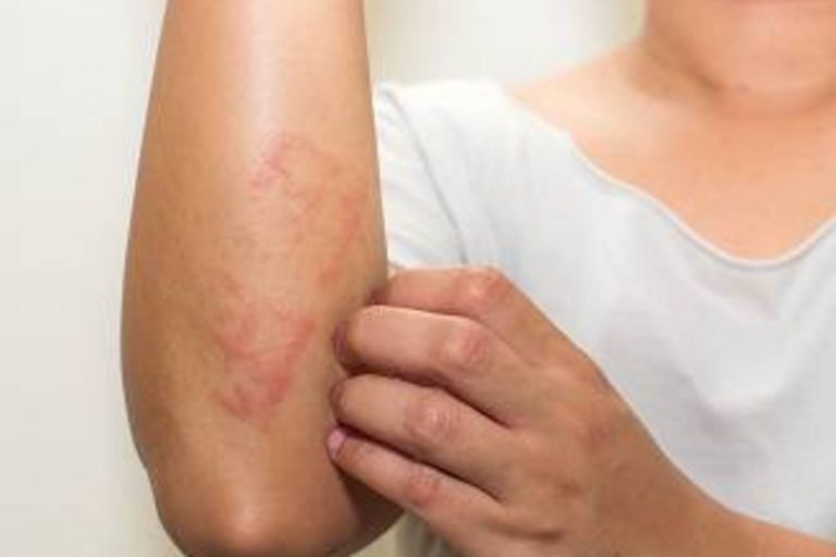 Alergia la susan, o afectiune tot mai des intalnita