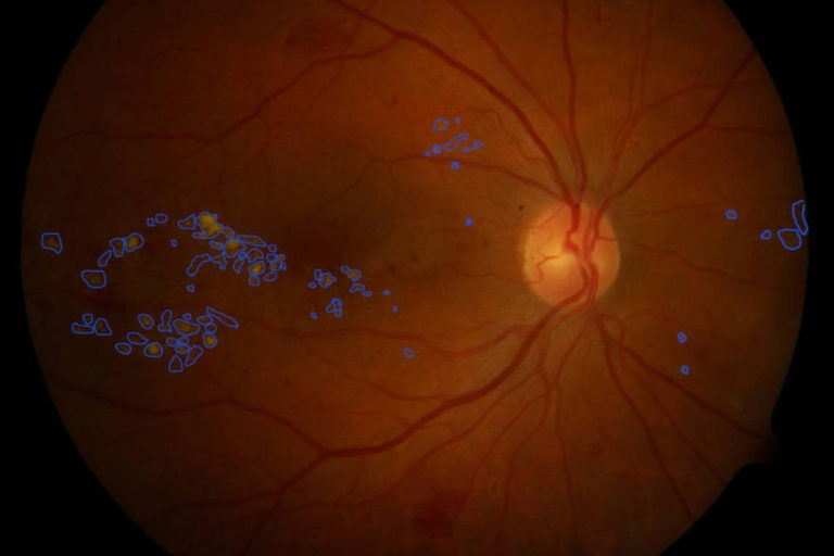 Inteligenta artificiala contribuie la salvarea vederii persoanelor diabetice