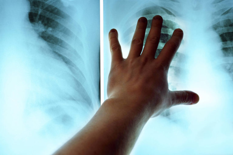 Stigma, conditia socialasi accesul dificil la servicii medicale, printre provocarile cu care se confrunta bolnavii de tuberculoza