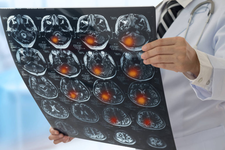 Studiu: Oamenii care traiesc in zone cu trafic zgomotos pot fi cu 30% mai predispusi sa faca accident vascular cerebral