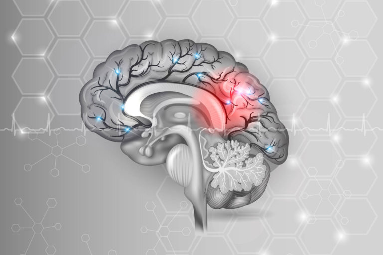 29 octombrie, Ziua Mondială a Accidentului vascular cerebral