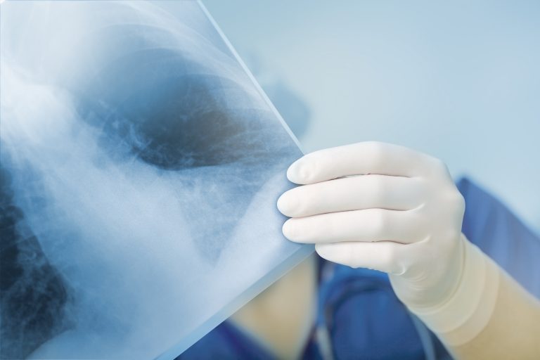 VIDEO Cum arată, din punct de vedere imagistic, afectarea pulmonară produsă de COVID-19?
