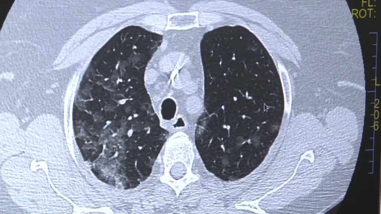Platformă unică în România pentru second opinion în cazul pacienților cu boli interstițiale pulmonare