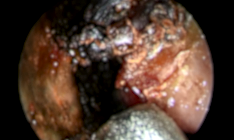 EXCLUSIV Ciuperca neagră (mucormicoza) depistată în România la pacienți post COVID-19