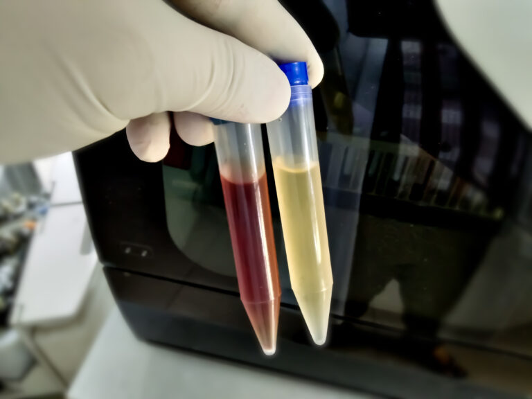 Studiu: Unele bacterii din urină pot fi un semn al cancerului de prostată agresiv