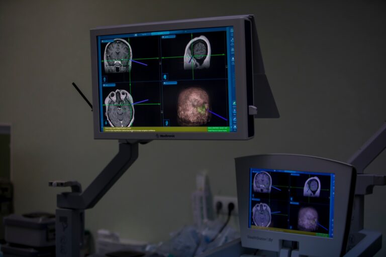 Spitalul Militar Central „Dr. Carol Davila”: Prima intervenţie de chirurgie în cazul epilepsiei farmacorezistente de cauză organică