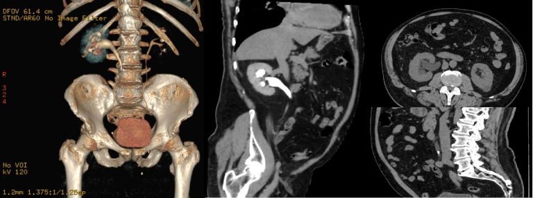 Spitalul de Boli Infecțioase și Pneumoftiziologie „Dr. Victor Babeș” Timișoara: Urografia prin tomografie computerizată poate contribui la detectarea precoce a afecțiunilor urologice