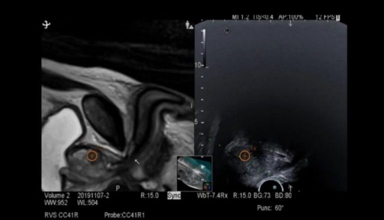Tehnologie avansată la SJUSM: Biopsiile RMN-fusion îmbunătățesc diagnosticul cancerului de prostată