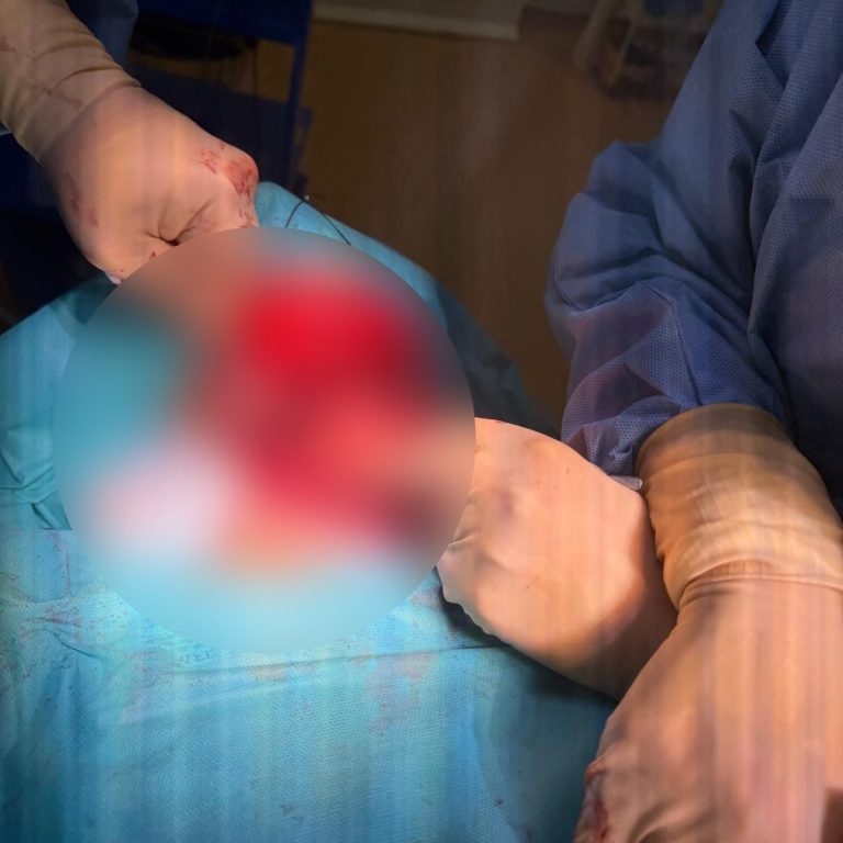 Laringectomie totală la un pacient diagnosticat cu neoplasm laringian recidivat, realizată în premieră la Spitalul Sf. Constantin