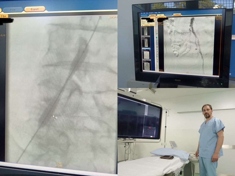 Premieră medicală la Spitalul Județean de Urgență Buzău: Intervenție complexă pentru o afecțiune arterială severă a membrelor inferioare