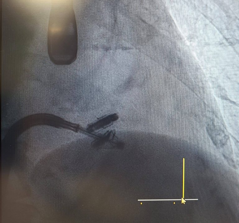 Intervenție de implantare percutană a dispozitivului PASCAL – TriClip, realizată în premieră la Spitalul Floreasca