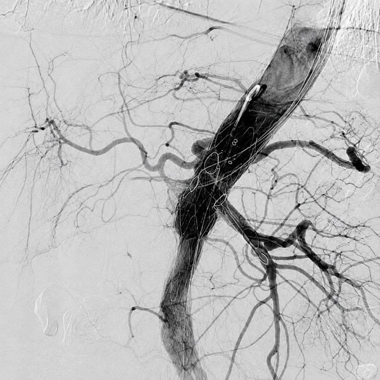 Pacient cu pseudoanevrism aortic juxtavisceral, tratat printr-o procedură endovasculară complexă la Clinica de Chirurgie Cardiovasculară Floreasca