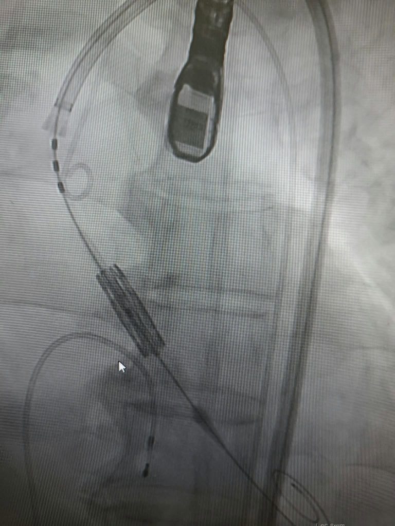 Intervenție TAVI realizată în premieră la Spitalul Floreasca pentru un pacient cu stenoză aortică severă și șoc cardiogen