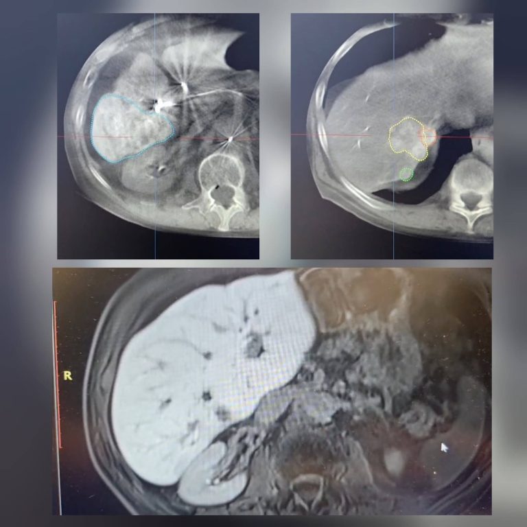 Prima procedură DSM-TACE din județ, realizată la SCJU Sibiu pentru un pacient cu carcinom hepatocelular